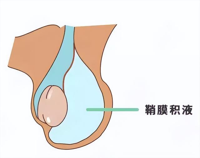 详谈鞘膜积液的预防方法有哪些