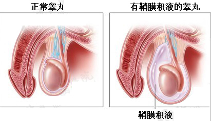 鞘膜积液会影响发育吗 介绍鞘膜积液对人的三个影响